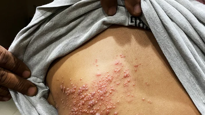 What Does Shingles Look Like on the Body